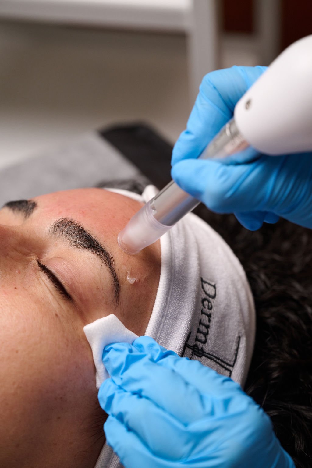Close-up of a gloved practitioner using a Dermaroller eTWIST microneedling device on a client’s face.