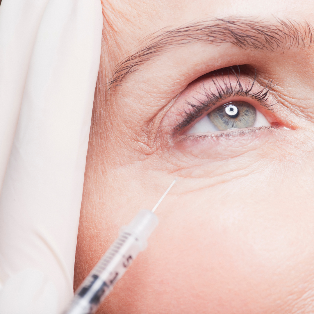 Woman in her 50s with visible signs of aging receiving Botox injections around the eyes