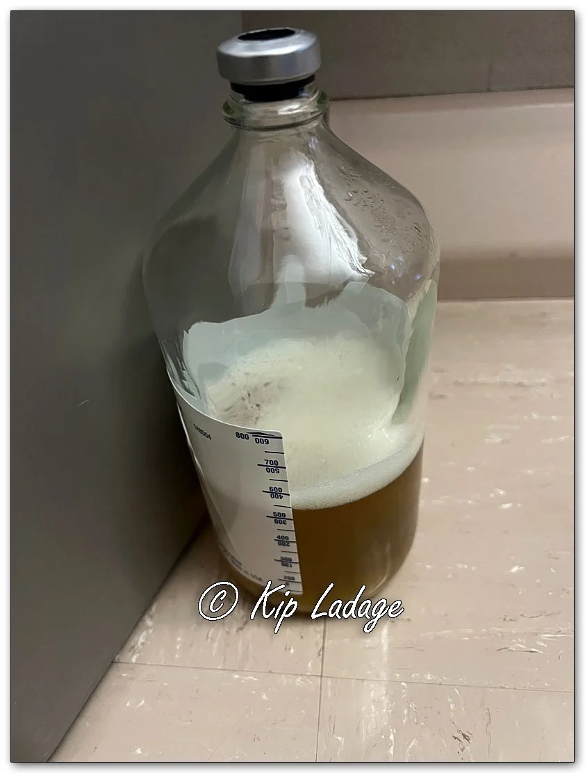 Pleural Effusion Fluid - Image 3310
