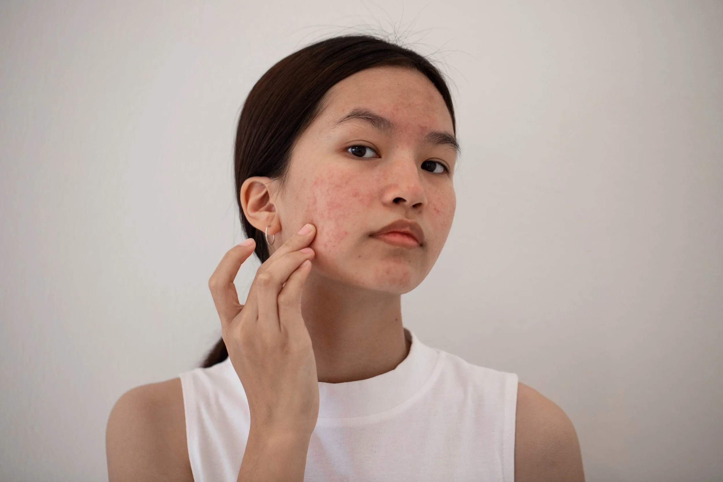 Best facials for acne-prone skin in St Marys