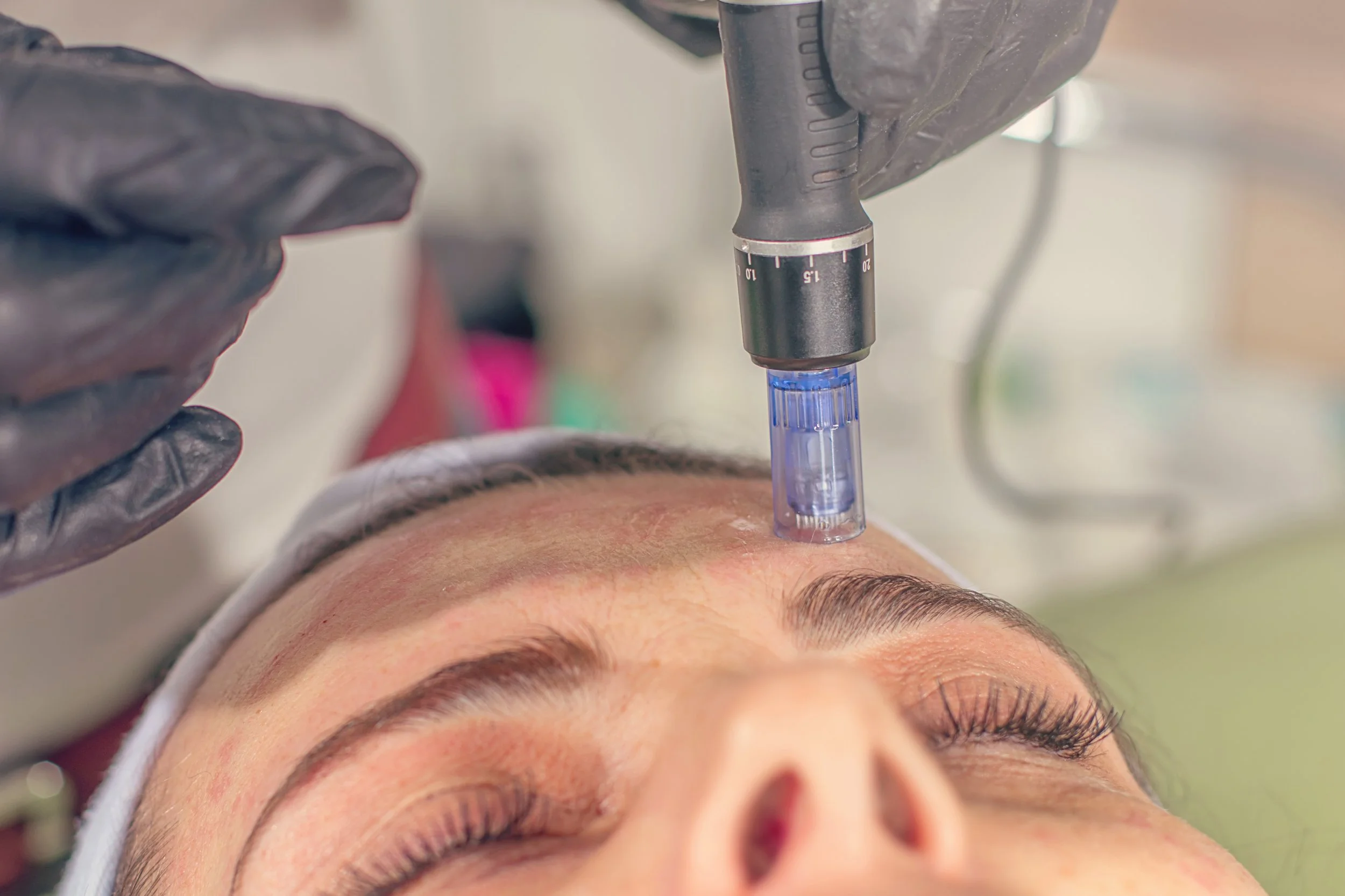 Skin Needling vs Mesoresurfacing: Which Is Better for Your Skin Concern?