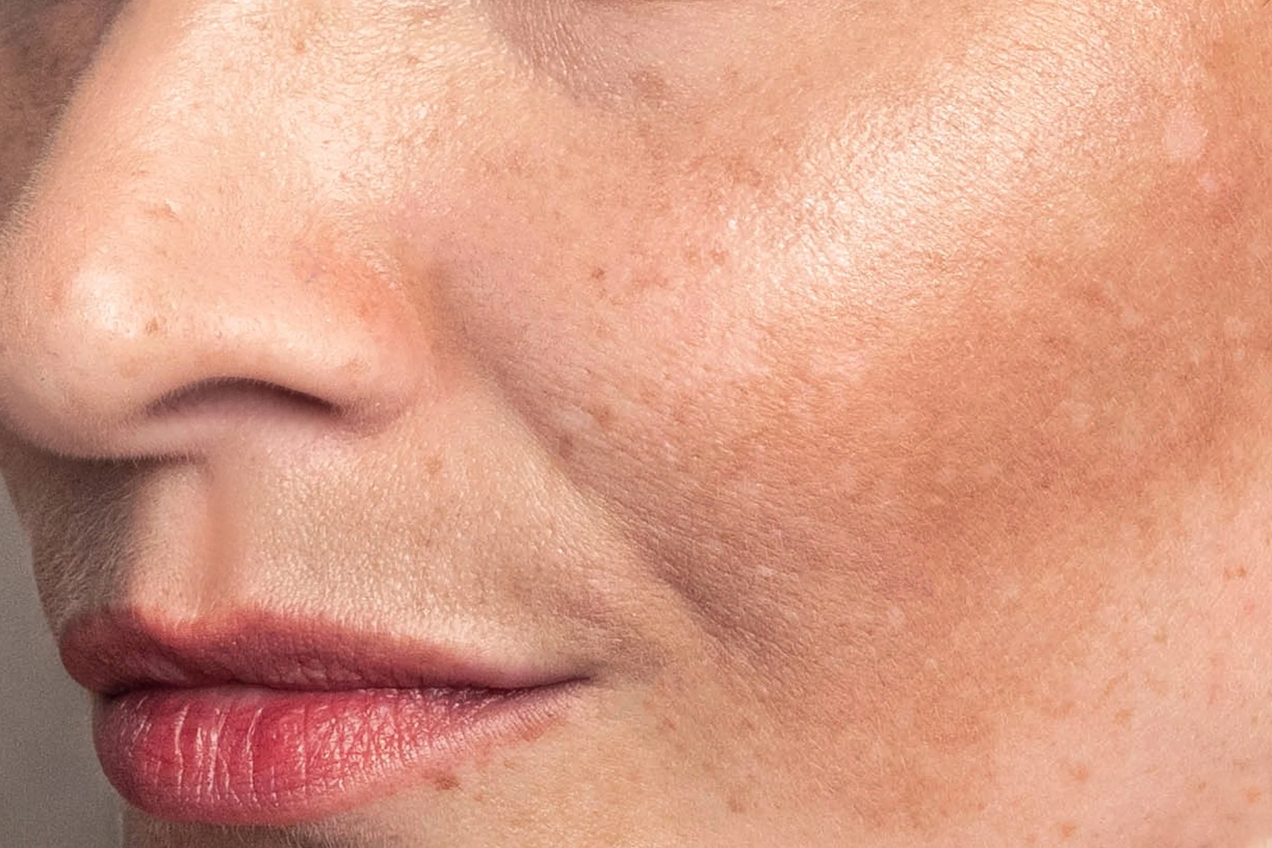 How to Treat Post-Acne Marks and Pigmentation Safely