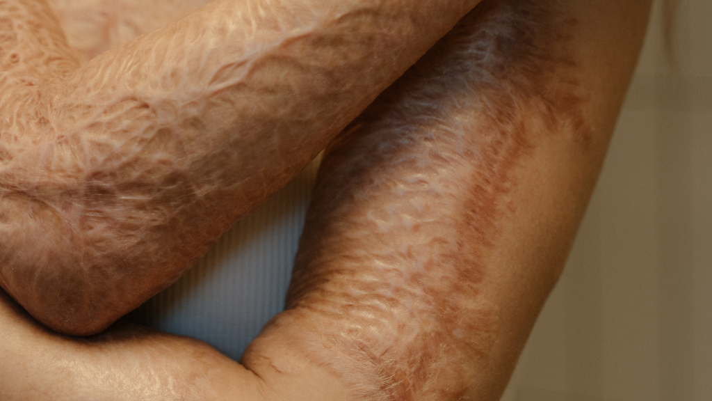 Burn Injury Claims: What You Need to Know