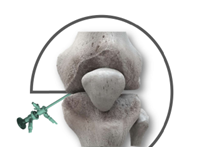 IORT - CADAVERWORKSHOP COMPREHENSIVE ARTHROSCOPY WORKSHOP ON THE ACL AND ITS SECONDARY RESTRAINTS – 2ND EDITION