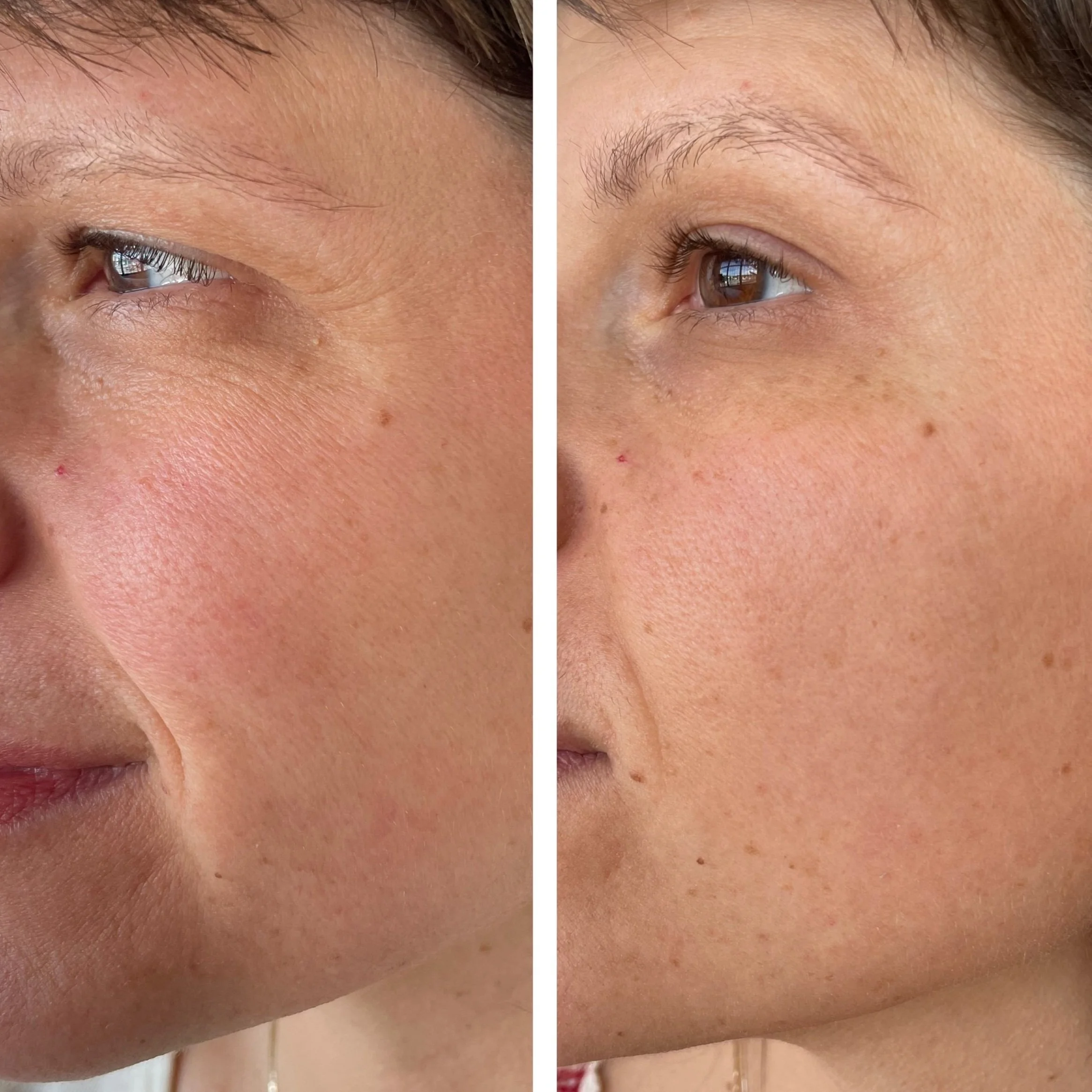 microneedlingmelissa3sessions.jpg
