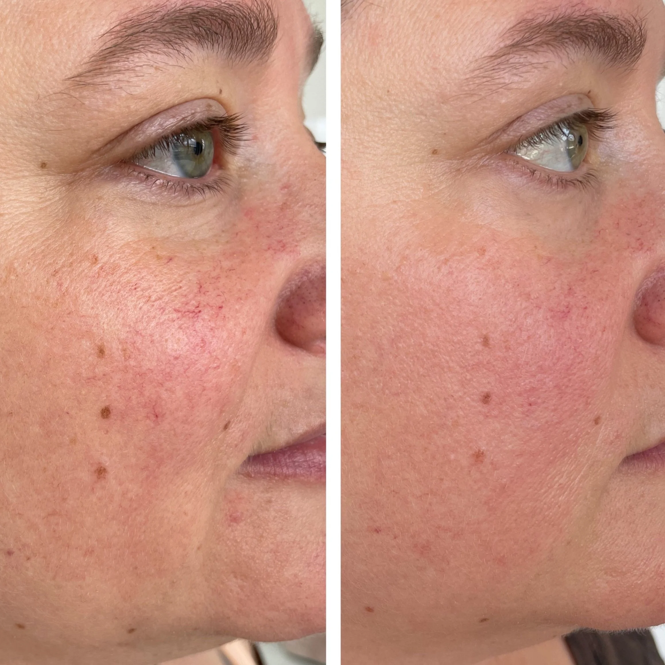 microneedlinggalen2sessions.jpg