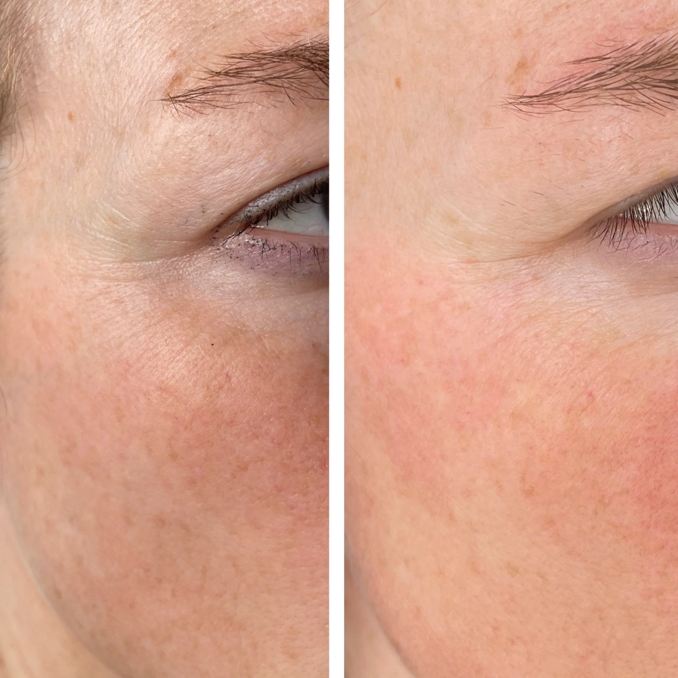 microneedlingliz2sessions2.jpg