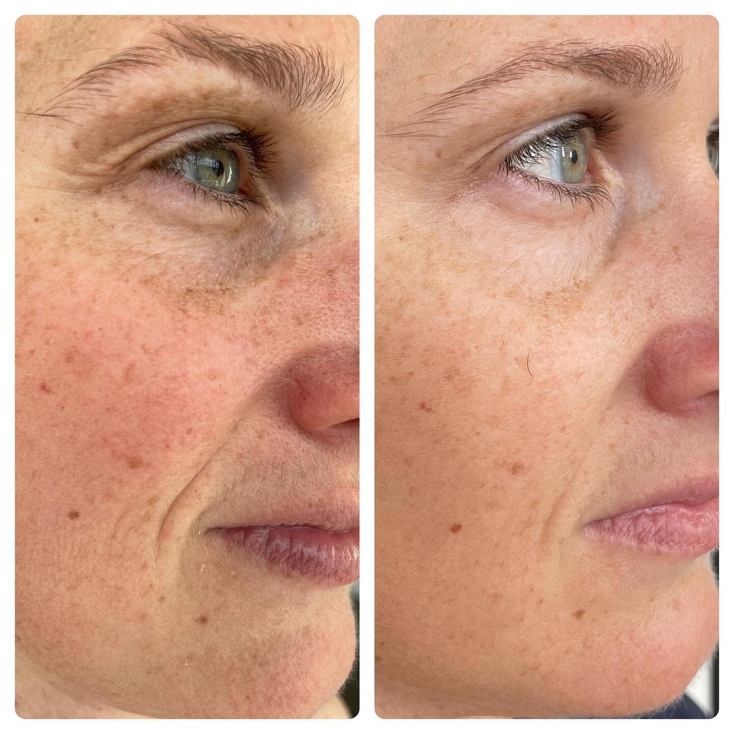 Four sessions of microneedling. By stimulating your body&rsquo;s own impressive wound healing mechanisms by way of thousands of tiny tiny pokes in the top layers of skin, a single session of microneedling increases collagen by 400-1000x!

All kinds o