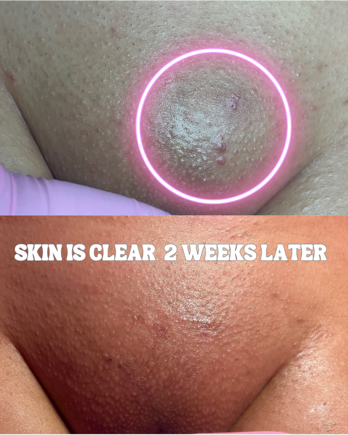A side-by-side comparison of a person's chin, showing a skin issue. The top image is a close-up of the chin with a pink circle overlay, displaying acne or pimples. The bottom image shows the same chin with clearer skin, accompanied by the text "Skin is clear 2 weeks later."