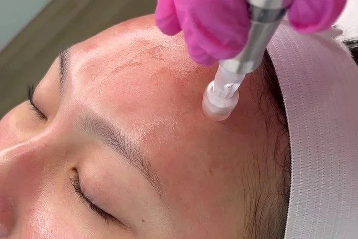 A woman lying down with her eyes closed receiving a facial treatment with a special device, while a practitioner uses gloved hands to apply the treatment on her face.