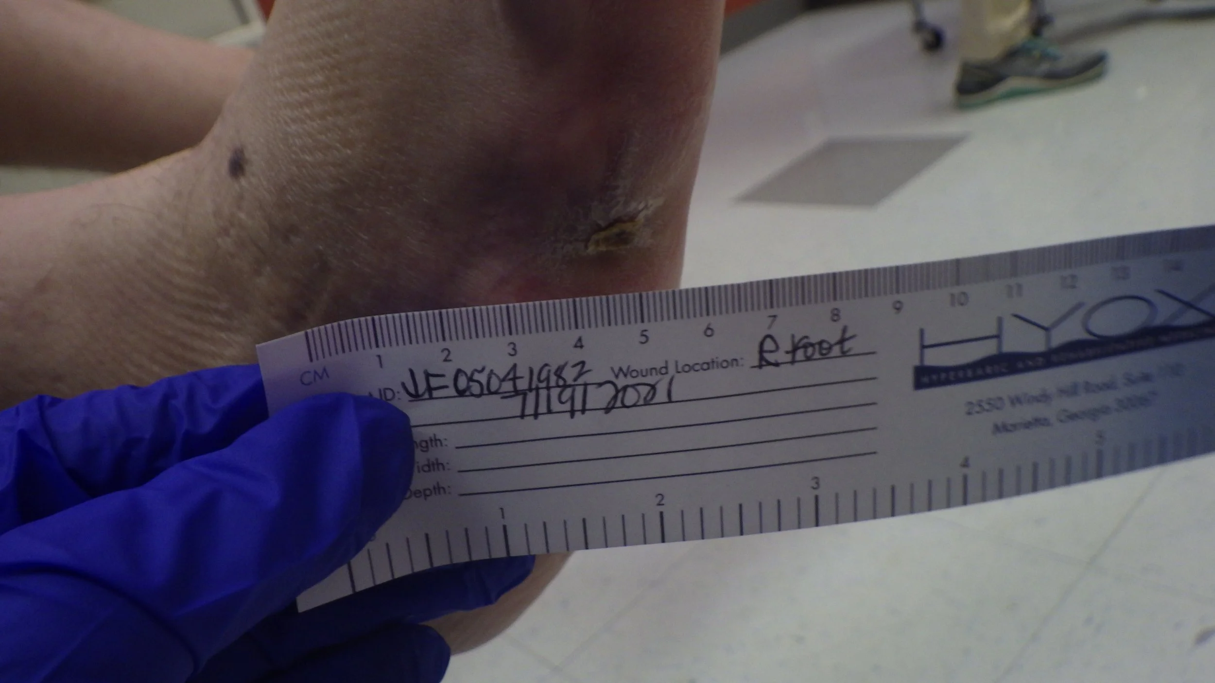 Chronic, NonHealing Wagner Grade 3 Right Lateral Foot Wound — HyOx