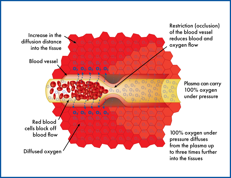 What are the Benefits of Hyperbaric Oxygen Therapy? The HyOx Team