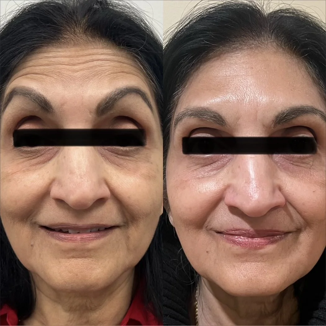 Facial Balancing (Filler and Neurotoxin)