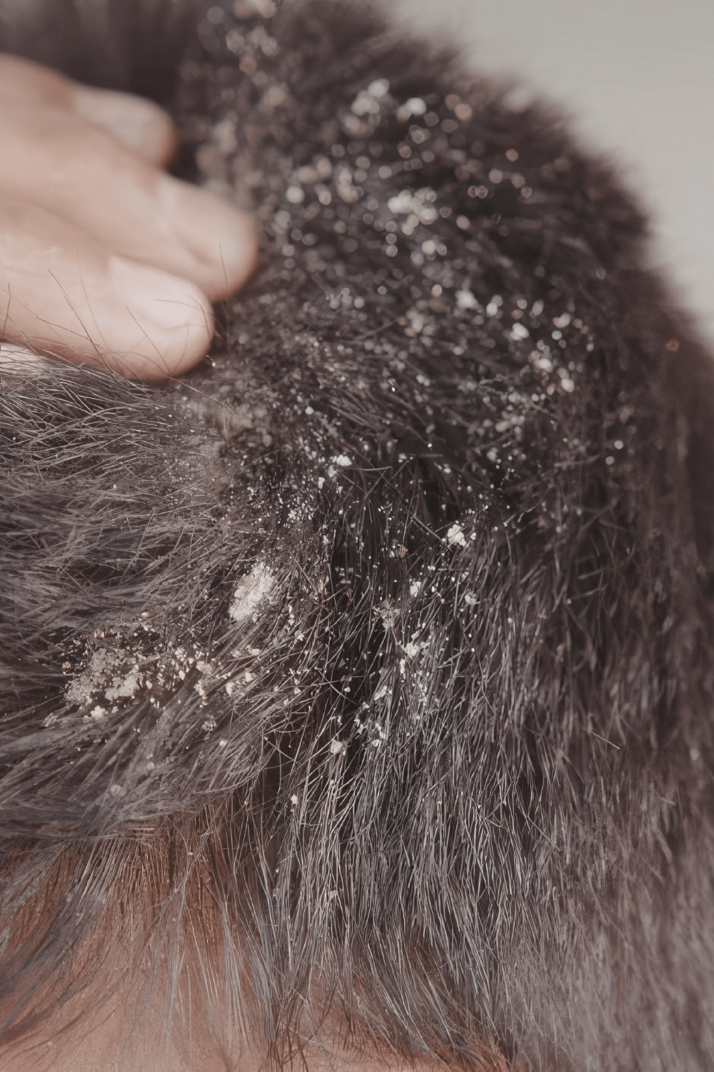 What you eat maybe causing your seborrheic dermatitis&nbsp;