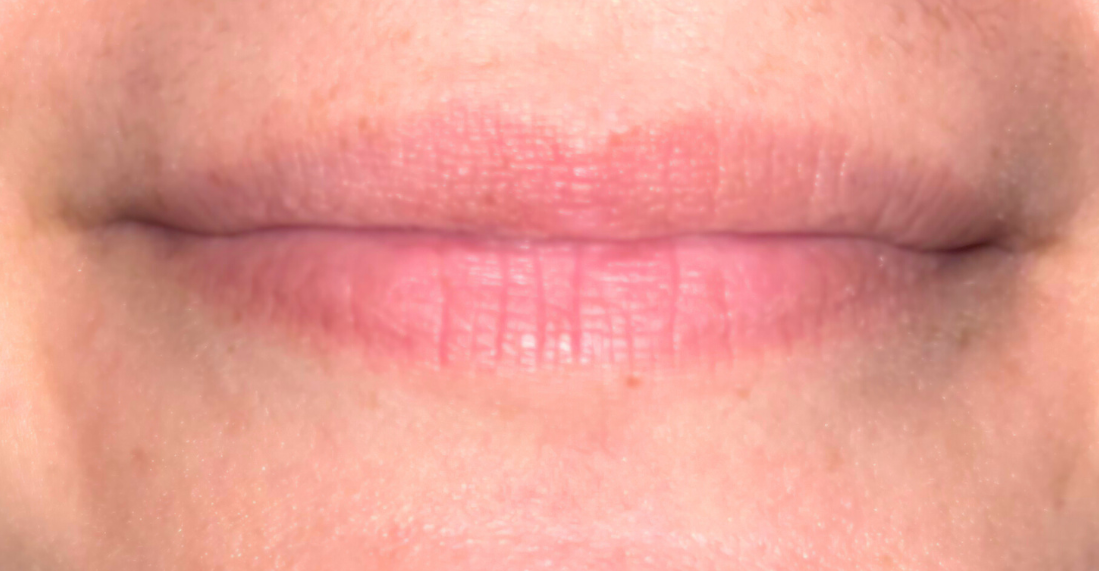 lip-flip-after-botox-boston-ma.png