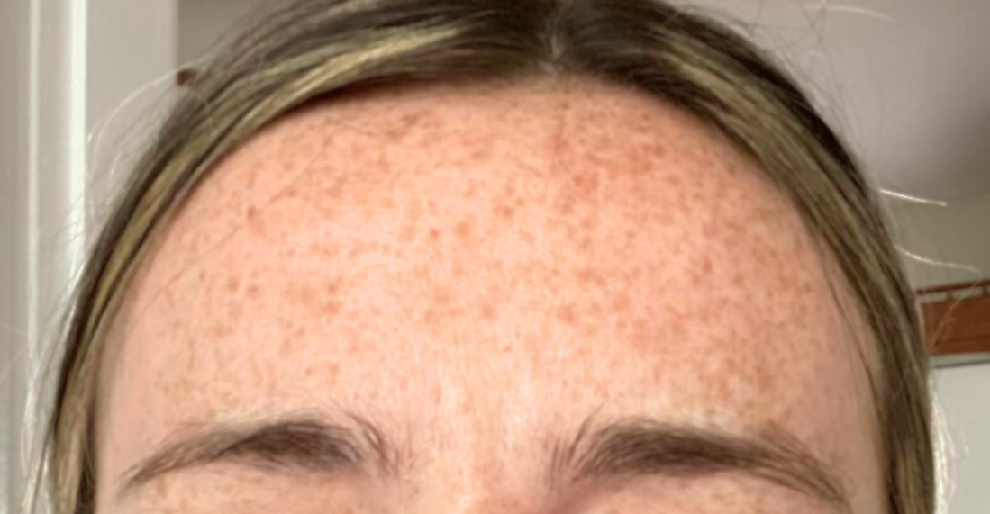 11s-glabella-after-botox-boston-ma.png