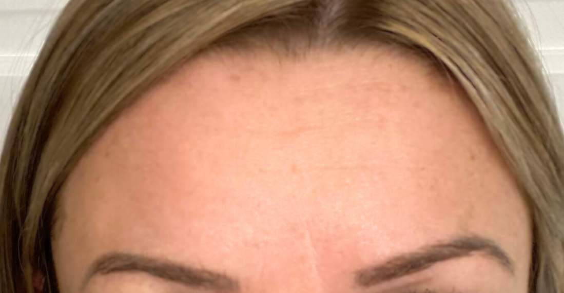 forehead-frontalis-botox-after-boston-ma.png
