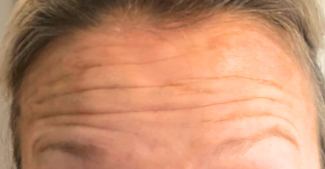 forehead-botox-before-boston-ma.png