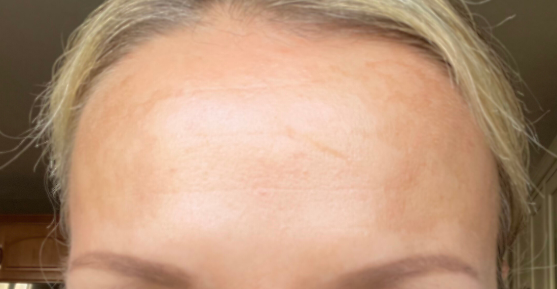 forehead-botox-after-boston-ma.png