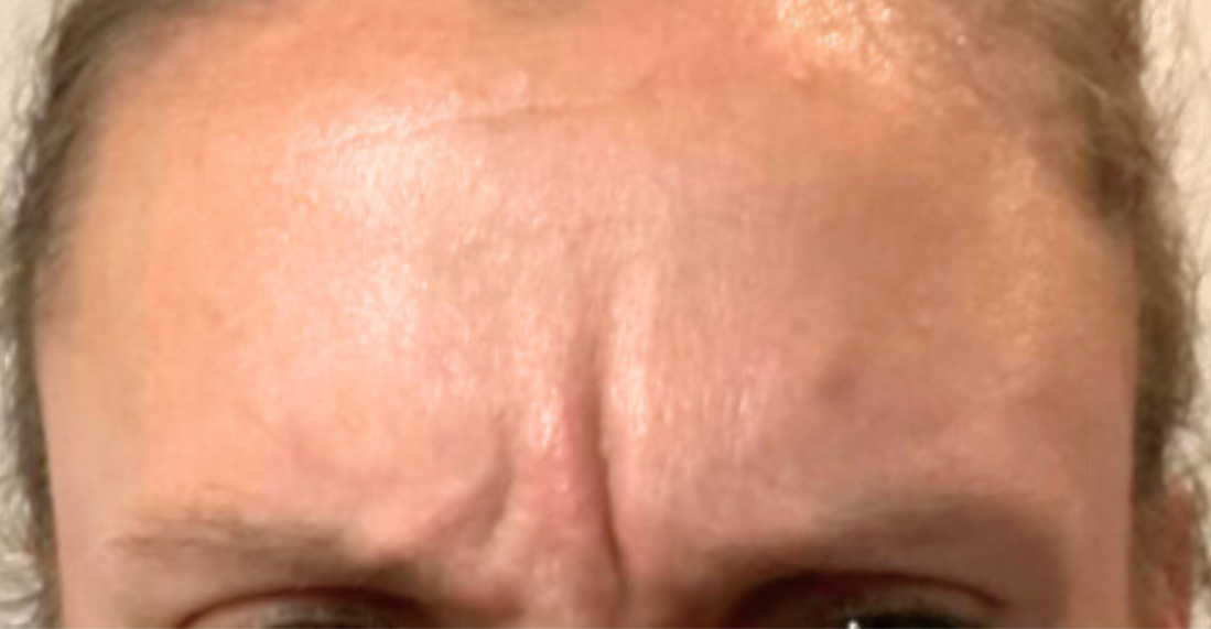 glabella-11s-before-botox-bosotn-ma.png