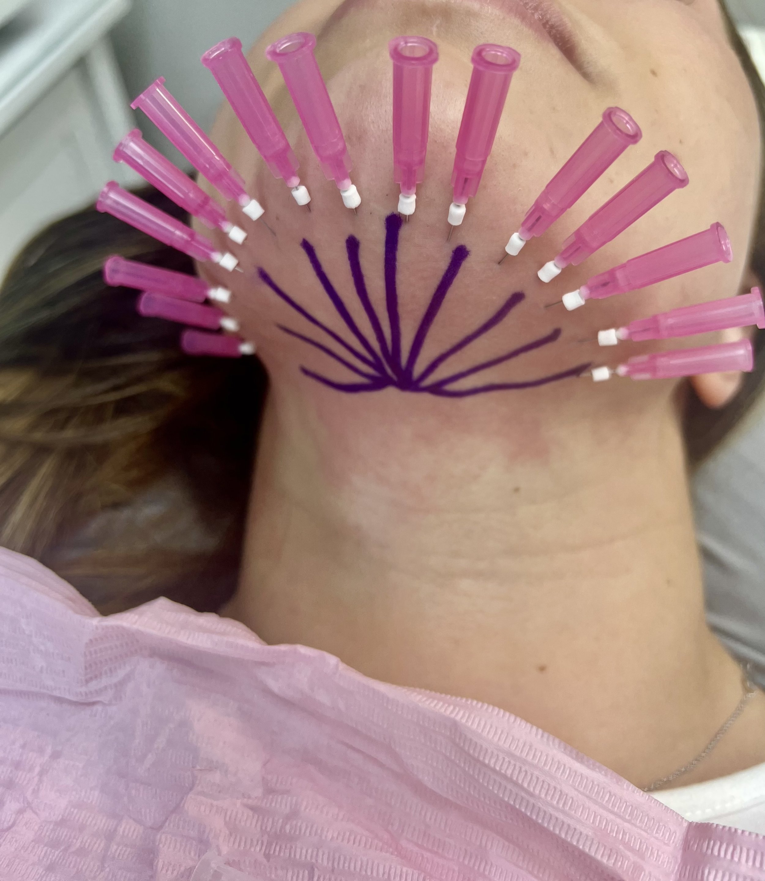 PDO Thread Lift — Sim's MedSpa