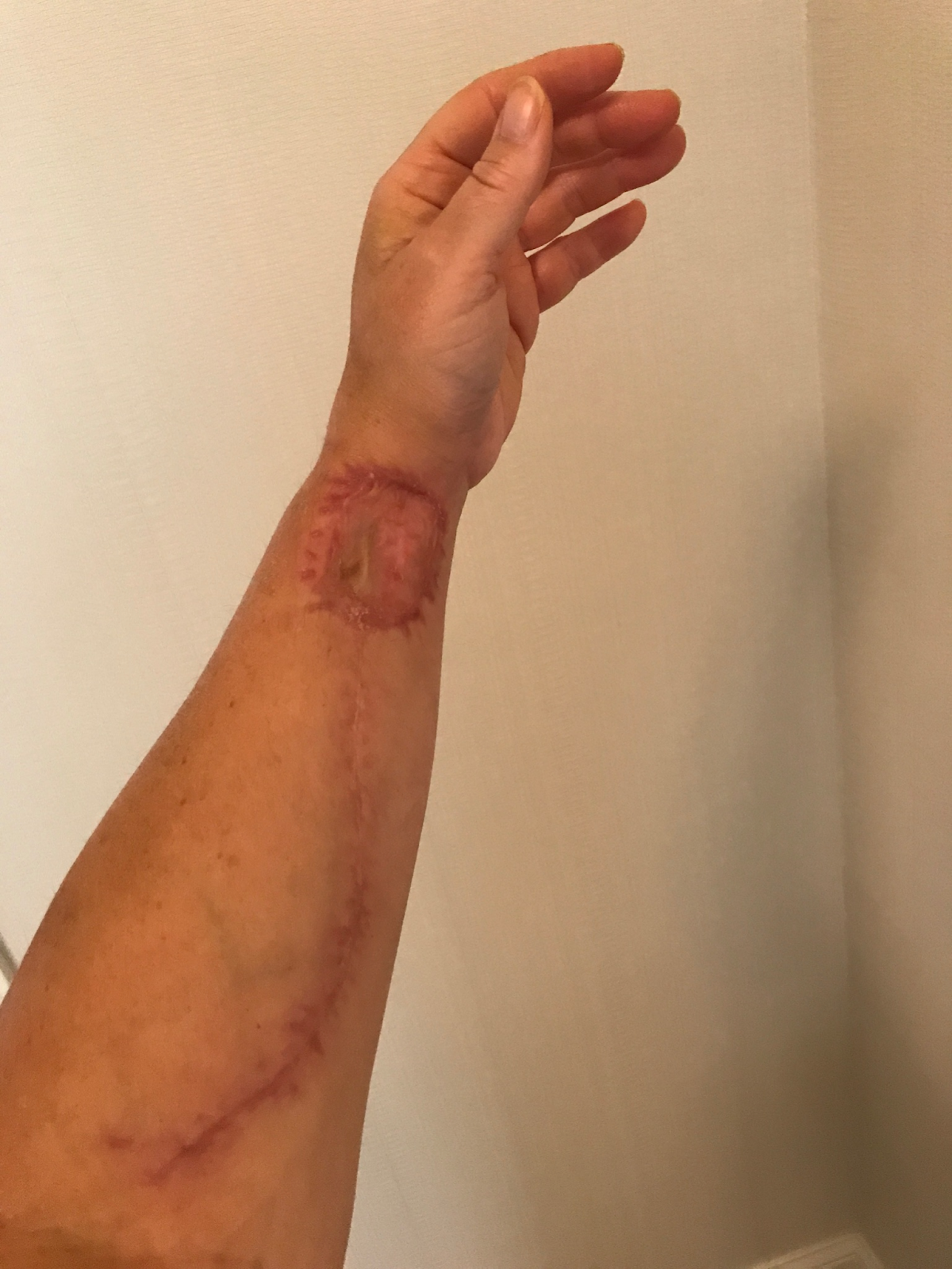 How do you cover an eight-inch scar on your arm?