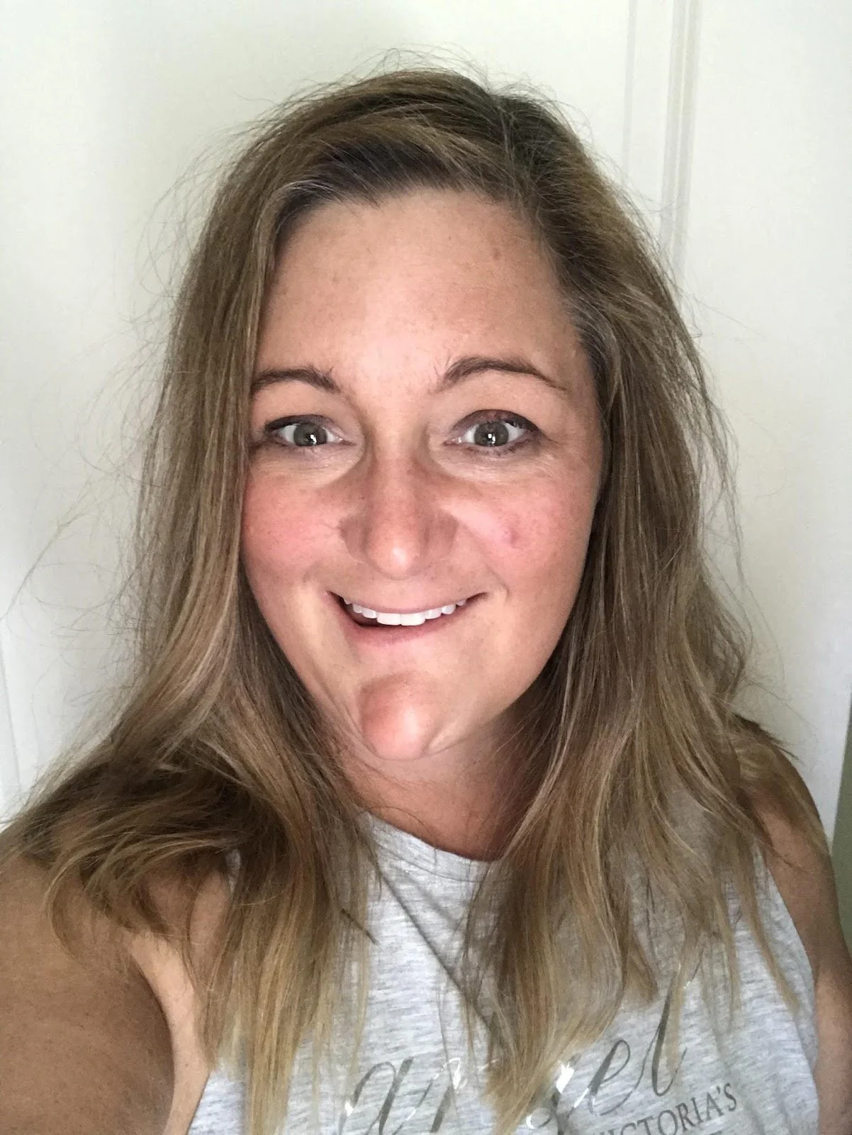 one month after glossectomy surgery