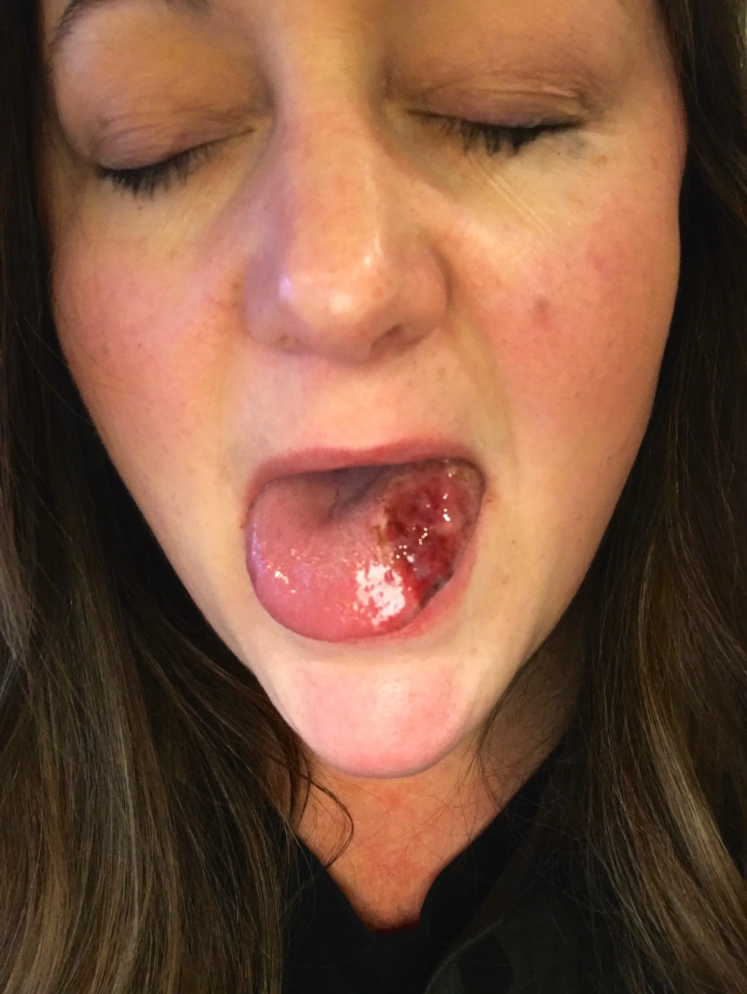 picture of tongue after ablation