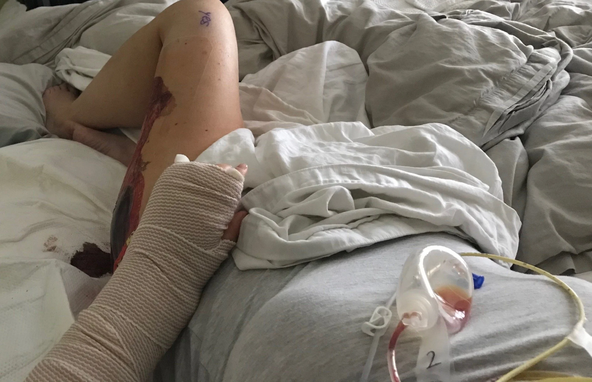 skin graft from my leg helping close wrists