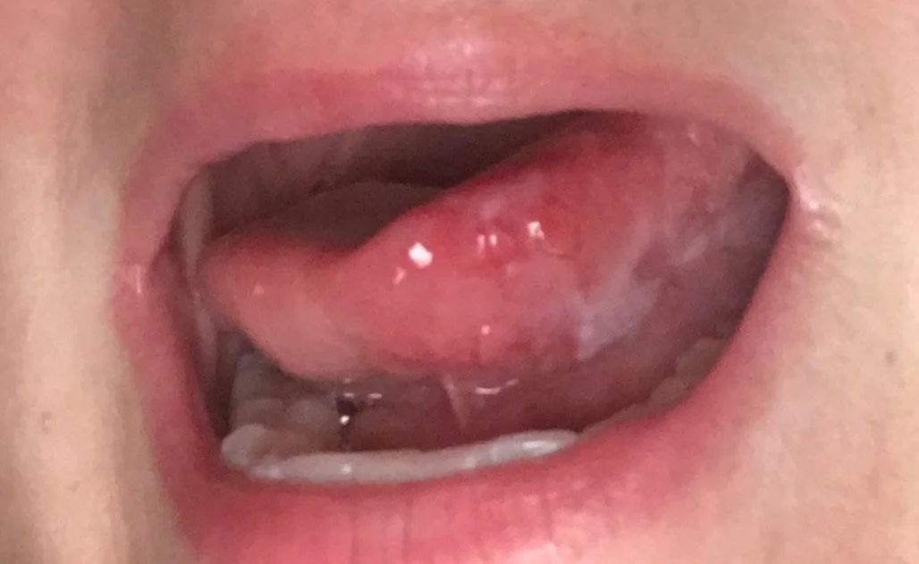 faint gray lines under my tongue during routine dental exam