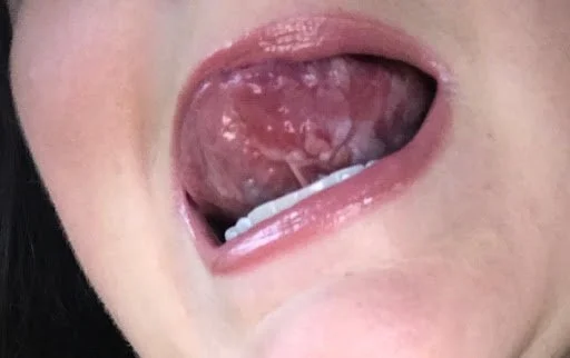 gray lines under tongue showing precancer