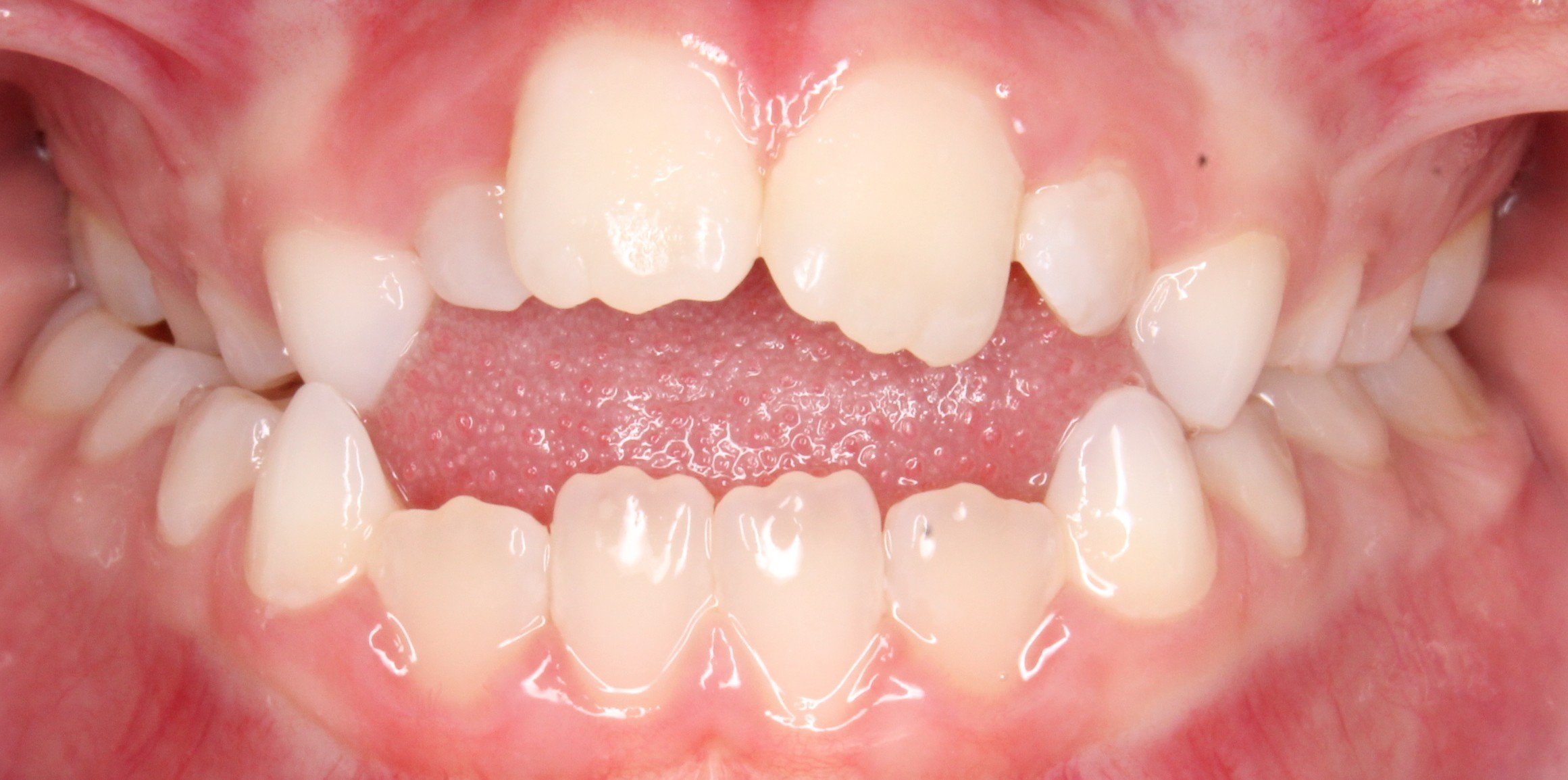The Benefits of (Early) Interceptive Orthodontic Phase 1 Treatment
