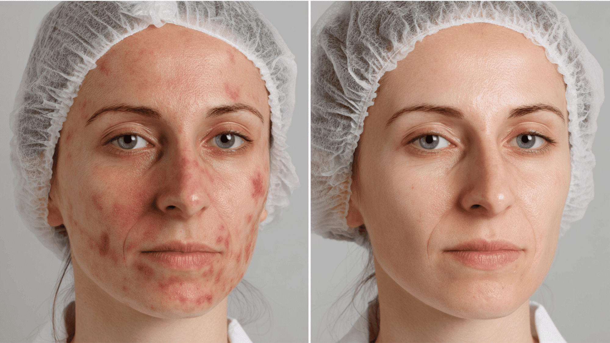 Side-by-side comparison of a woman's face before and after skincare treatment, showing improved skin clarity and texture.