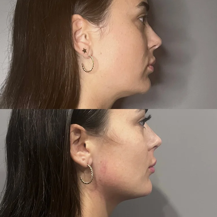 Ultraformer MPT HIFU Perth before and after — 3 sessions