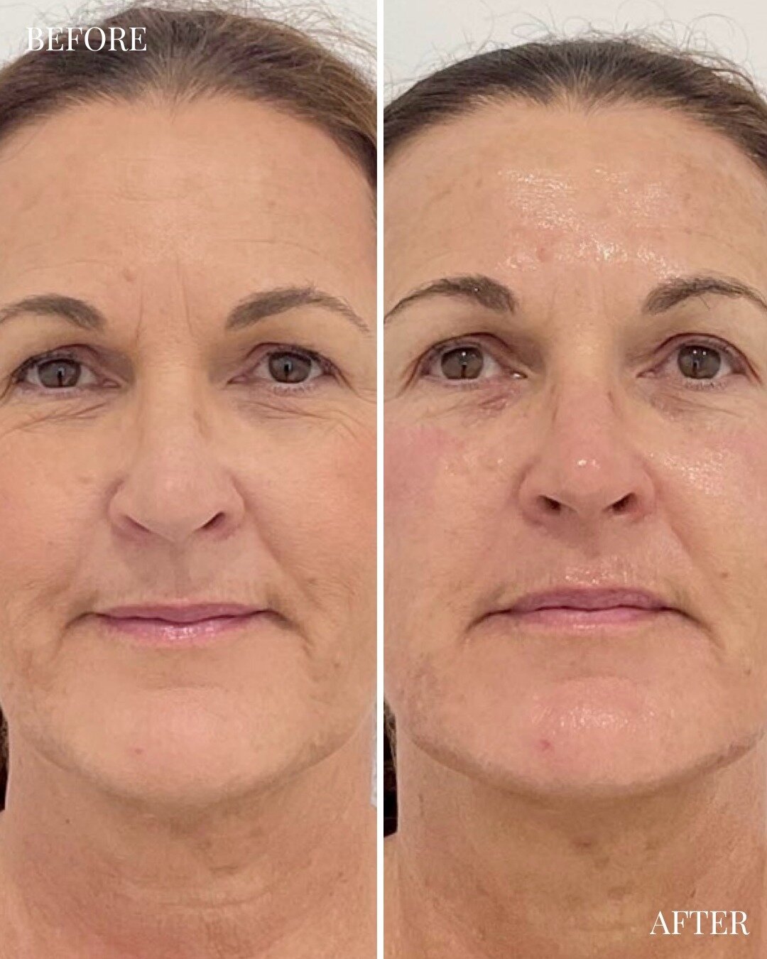 We love a before &amp; after 🤍 

Our NOTOX facial is a non-toxic, non-invasive, non-injectable facelift that achieves a lifted, contoured and rejuvenated appearance. No pain, no worries!

Send us a DM to find out all the details!

#shapeofyou #bodyc