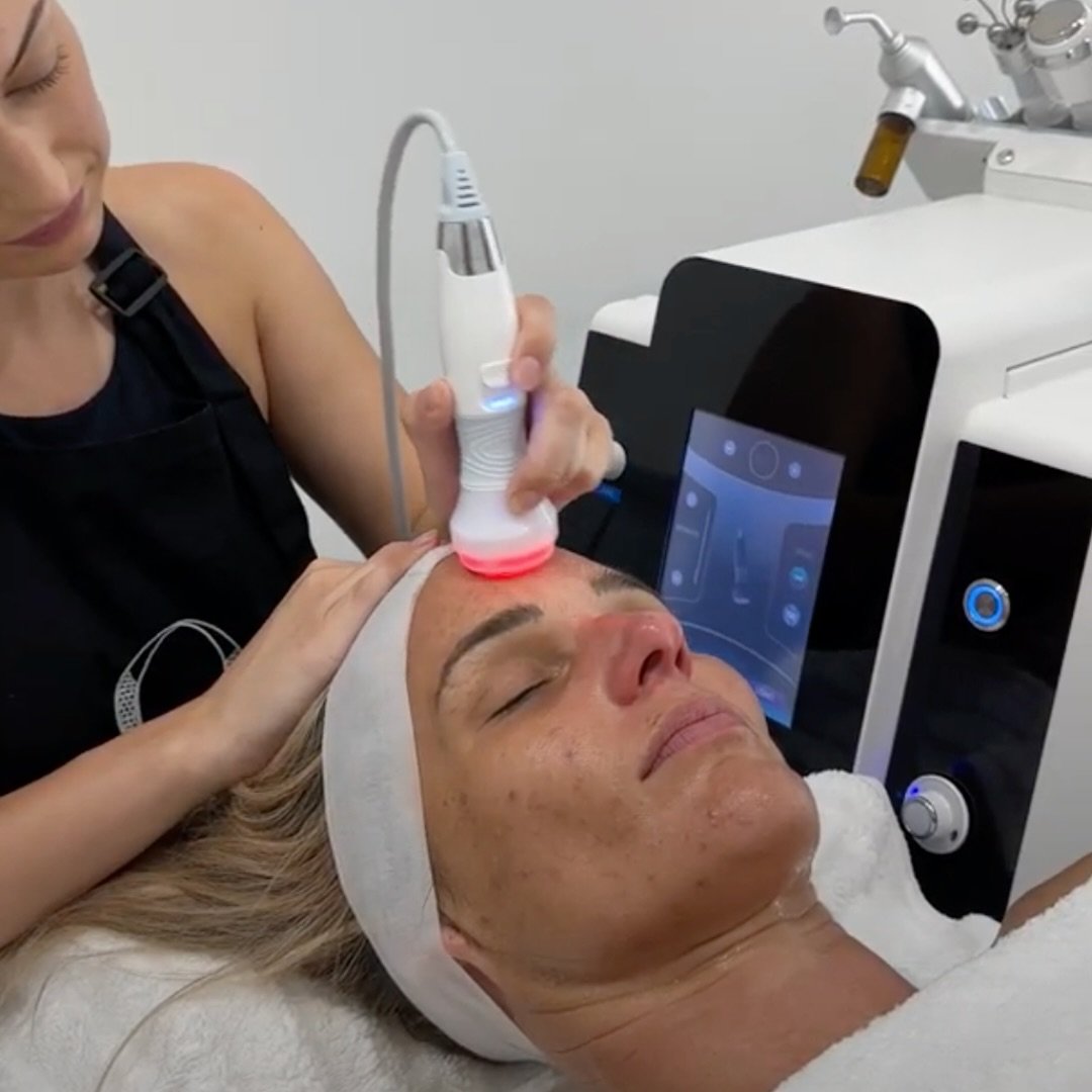 RF Skin Tightening, a natural solution to help with your anti-ageing goals. 

The perfect add on to any skin treatment, targeting the tissue beneath the epidermis to stimulate new collagen production. 

#radiofrequency #radiofrequencyfacial #skinclin
