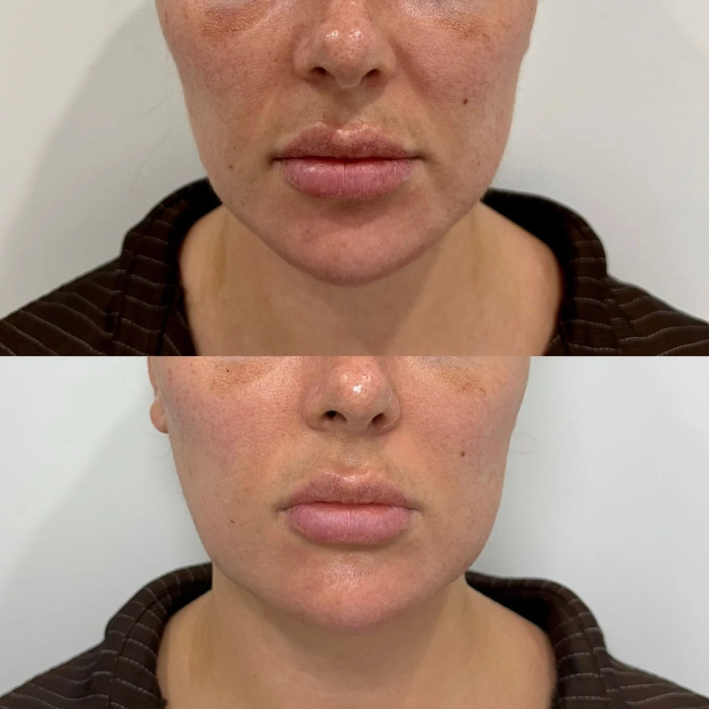 Smoother smile lines and a more supported lower face ✨

A beautiful lift through the jowls, softer folds and a more refined mouth area.

We don&rsquo;t know who was happier&hellip; us or the client 😂

Let&rsquo;s break down the changes you can actua