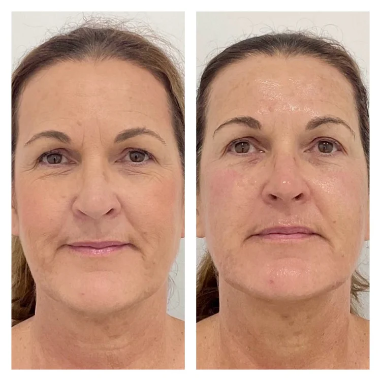 Ultraformer MPT HIFU Perth before and after — 1 session