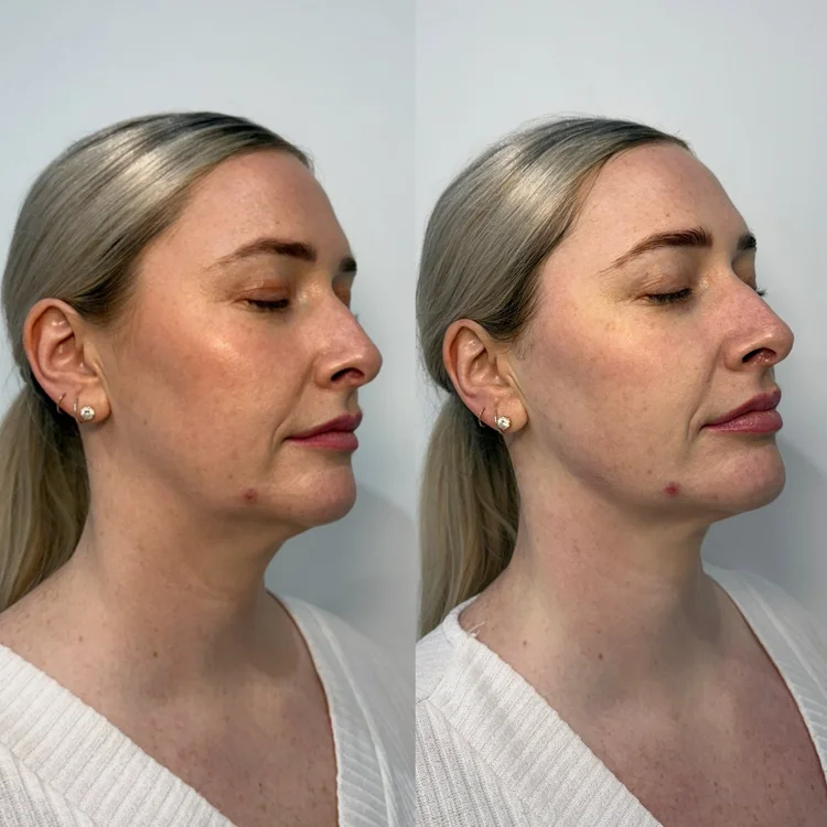 Ultraformer MPT HIFU Perth before and after — 2 sessions