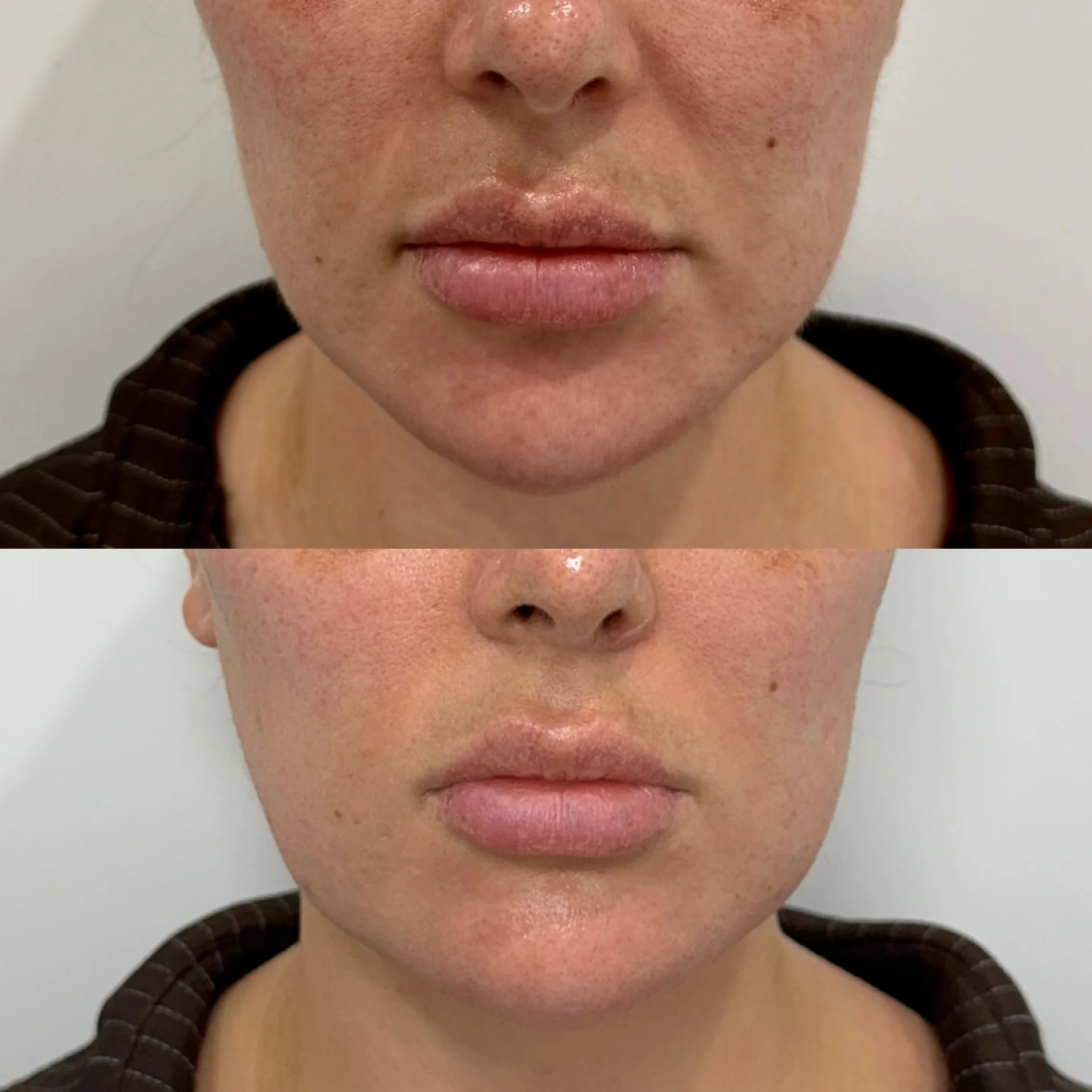 Close-up of a person's face showing freckles, pink lips, and a small mole on the right cheek. The person is wearing a dark, checkered top.