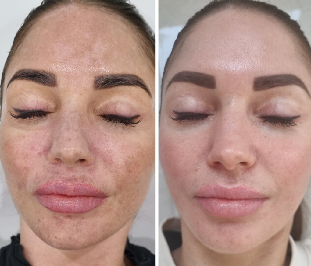 Side-by-side comparison of a woman's face before and after skincare, showing reduced freckles, smoother skin, and enhanced eyebrow makeup.