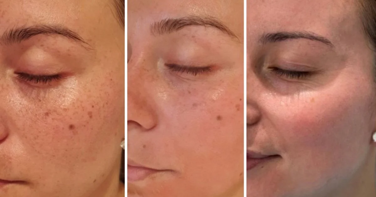 Close-up of a woman's face showing the progression of skin clearing, from left to right, with diminishing freckles and dark spots.