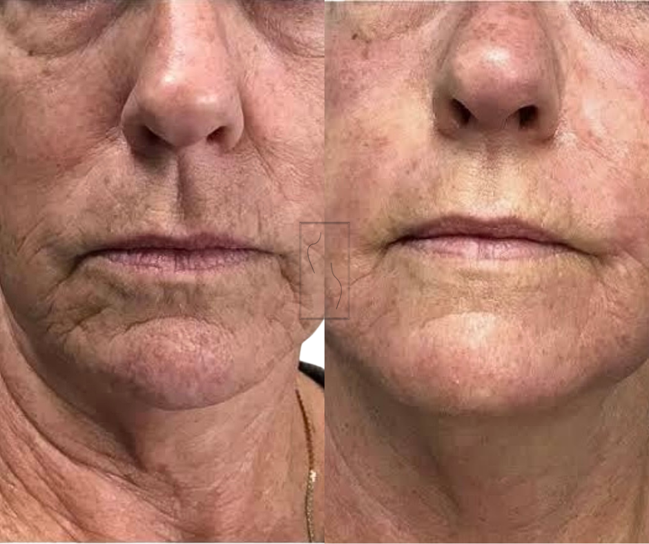 Skin needling before and after — ageing and skin texture result