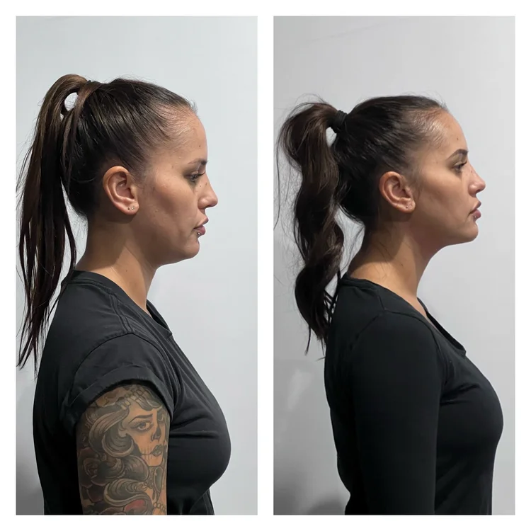 Ultraformer MPT HIFU Perth before and after — 3 sessions