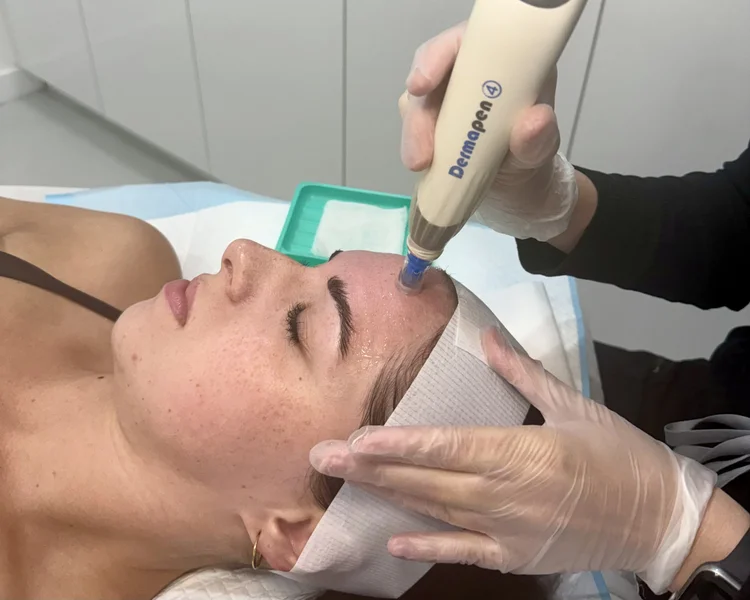 Dermapen 4 skin needling treatment in Perth at Shape of You