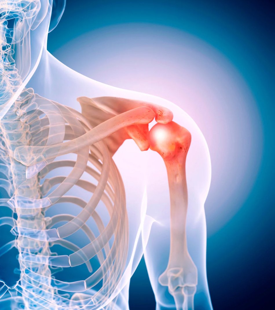 Did You Really Dislocate Your Shoulder? Why It Might Be Something Worse (And What to Do About It)