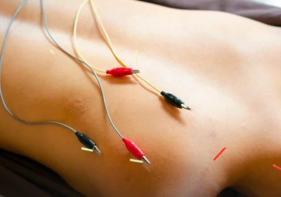 A patient receiving acupuncture treatment, with fine needles placed along their back for therapeutic relief