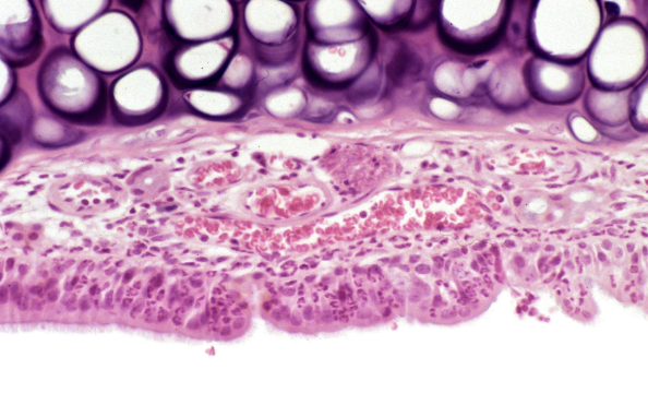 Increased white blood cells