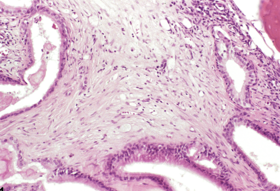 Fibrosis