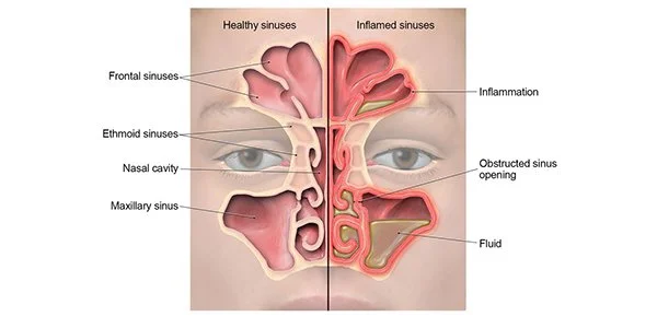 How to Actually Get the Right Sinus Diagnosis